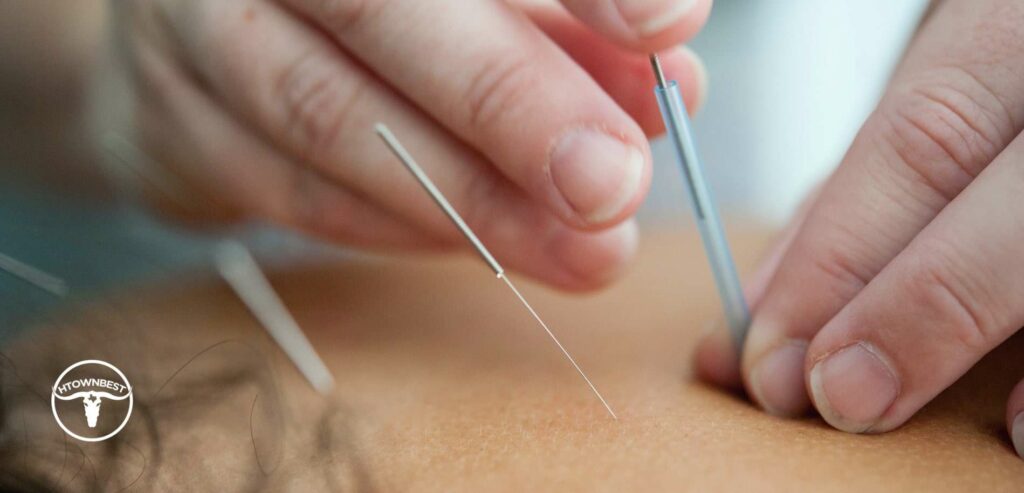 5 Best Acupuncture Clinics in Houston
